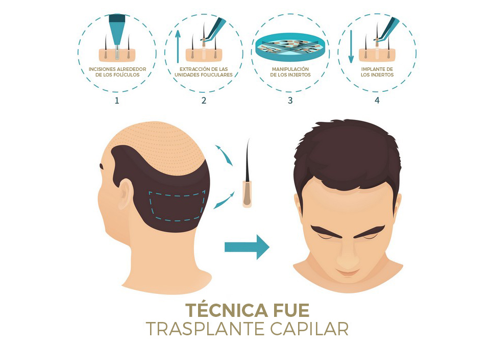 Injerto capilar en Sevilla | Salus Medical Clinic